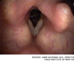 Typical findings of LPR: Pseudosulcus, ventricular obliteration and marked posterior laryngeal thickening.