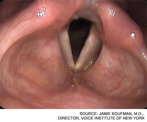 Same patient after 8 weeks of treatment (diet and medication). The ventricles are open and the vocal folds are thin; the entire posterior larynx is also dramatically improved.