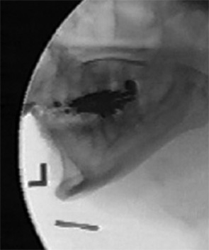 Fluoroscopic image, illustrating the pharynx at maximum constriction.