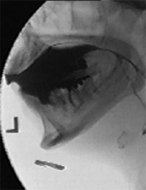 Fluoroscopic image, illustrating the pharynx at rest.