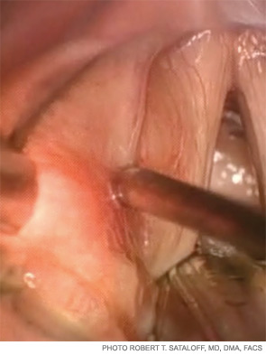 Needle position for left fat injection