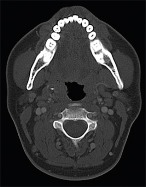 Figure 1: Coronal CT scan.