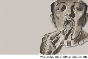 A medical illustration from 1923 showing a tonsillectomy. The guillotine is in the left hand, introduced with its fenestra under the lowermost limit of the left tonsil, at the junction of the faucial with the lingual tonsil tissues.