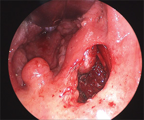 Figure 3: An arrow points to the styloid process.