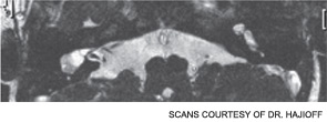 MRI showing abnormal cochleo-vestibular morphology