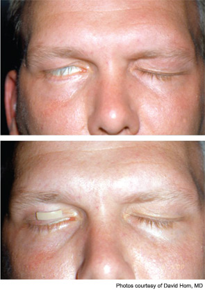 Various gold weight templates are used to determine the optimal size needed to improve eyelid closure.