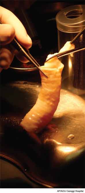 A surgical team at AOU Careggi Hospital in Italy prepares a trachea before inoculating it with stem cells and transplanting it into a cancer patient.