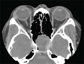 CT scan