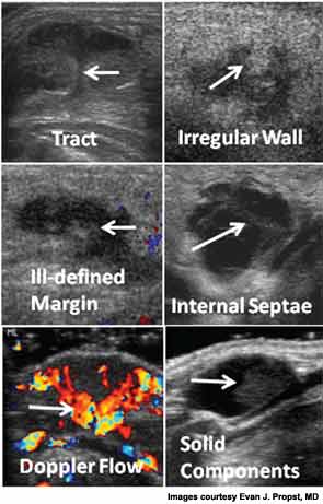 Researchers have identified six ultrasound features that have high PPV in distinguishing between dermoid and TGDCs.