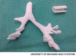 The 3D-printed stent next to a model of Kaiba Gionfriddo's airway, with the malacic left bronchus.