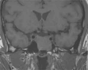 T1-weighted image showed a rounded mass