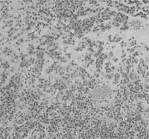 Histological examination showed plasmacytoid cells with<br /><br /><br /><br /><br /> eccentric nuclei and dense eosinophillic cytoplasm