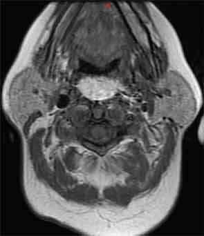 Figure 1a, 1b. Axial and sagittal contrast-enhanced
computed tomography of the neck displays a 8.3 x 4.4-cm low-density retropharyngeal mass.