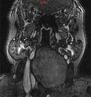 Figure 1a, 1b. Axial and sagittal contrast-enhanced
computed tomography of the neck displays a 8.3 x 4.4-cm low-density retropharyngeal mass.