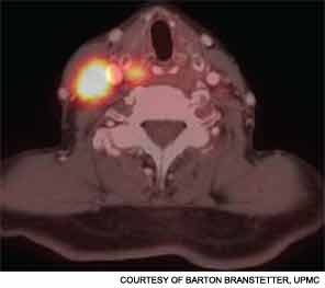A fused PET/CT scan shows a subtle hypopharyngeal tumor responsible for large metastatic nodes in the right neck. Evaluation of unknown primary tumors is one of the many well-established indications for PET/CT in head and neck oncology.