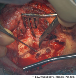 Removing the posterior canal wall